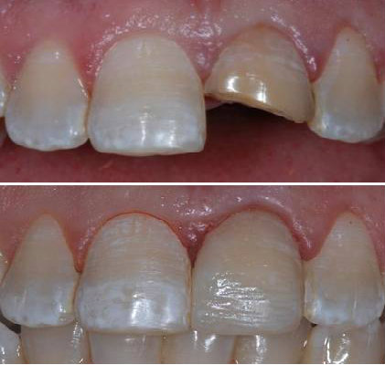 light cure filling