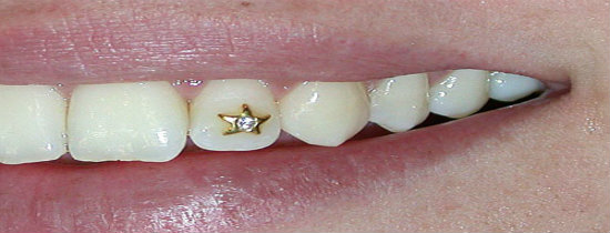 gic tooth filling